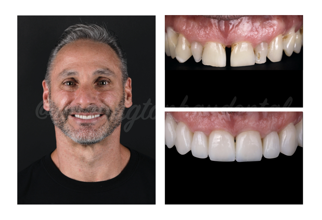 Long Island client of Huntington Bay Dental before and after veneers