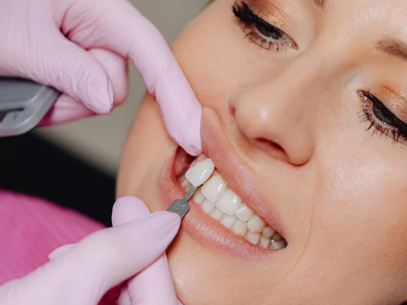 dentist fitting dental veneer to a woman patient