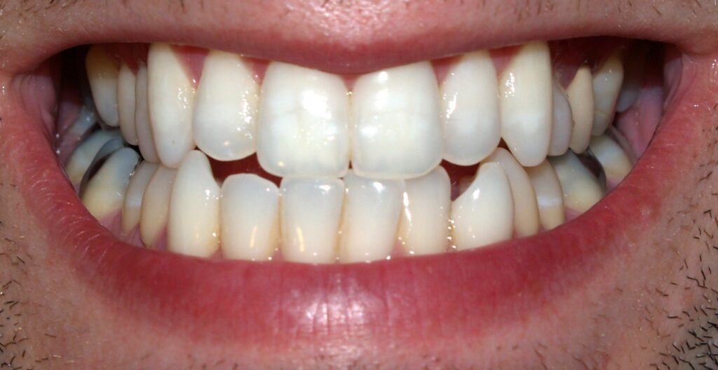 translucent, see-through teeth with enamel loss