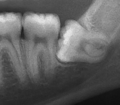 horizontally impacted tooth on an xray