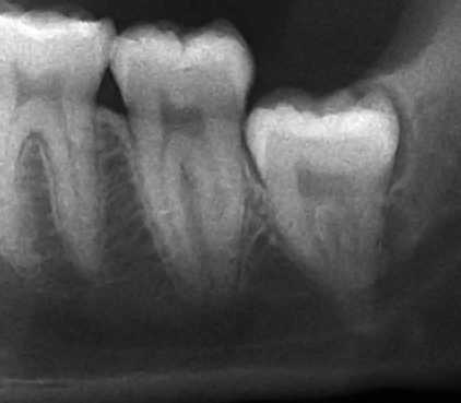 impacted wisdom tooth horizontal