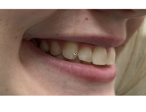 What You Should Know About Tooth Gems